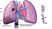 آمبولی ریه
